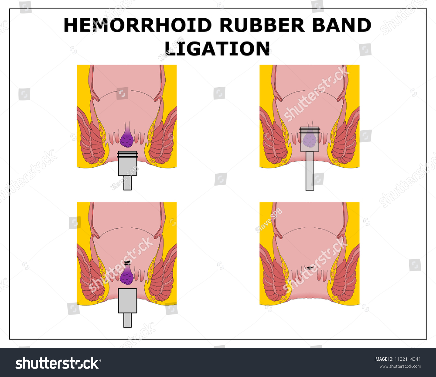 hemorrhoid rubber band