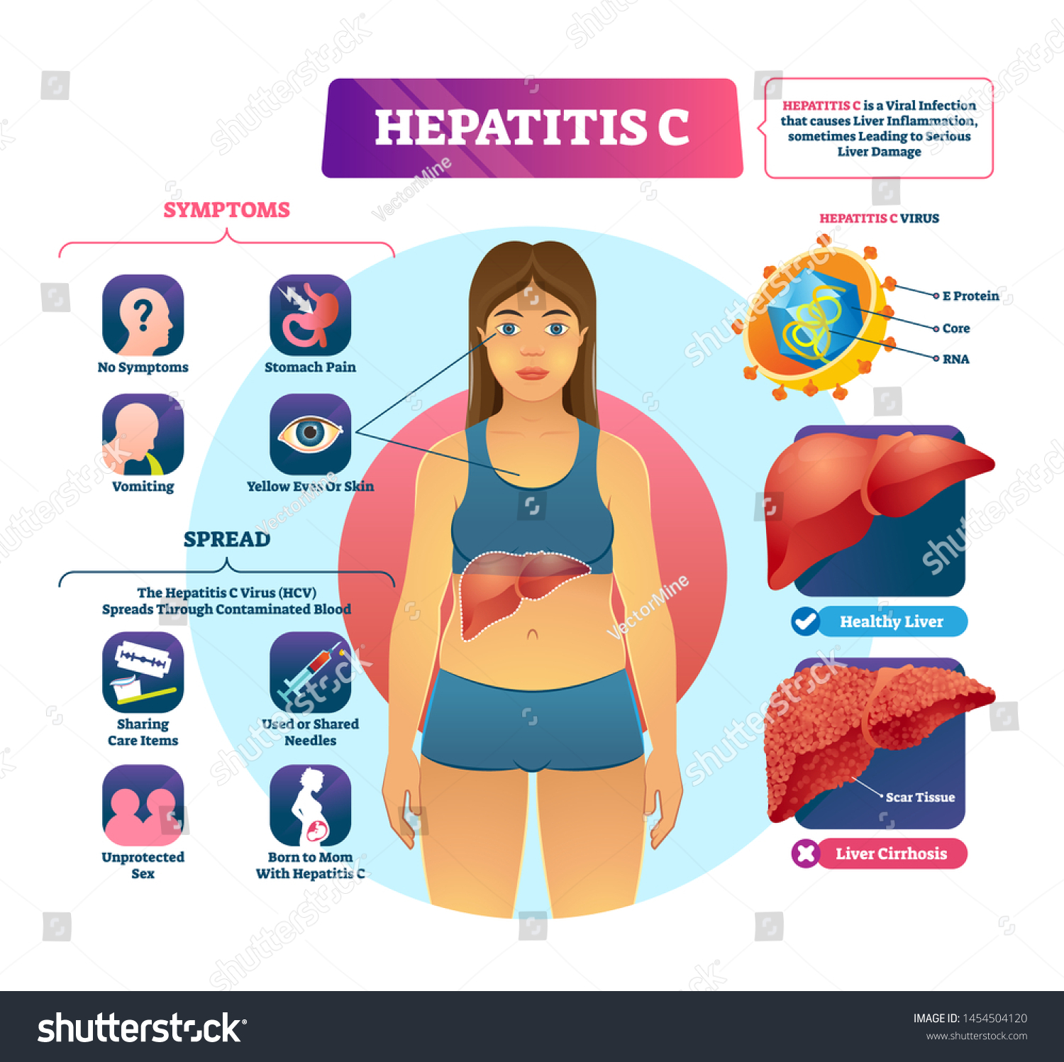 Hepatitis C Vector Illustration Labeled Viral Vector De Stock Libre De Regal As