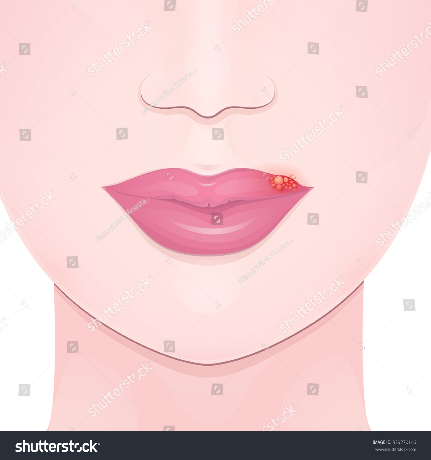 Herpes Closeup Lips Cold Sore Upper Stock Vector Royalty Free