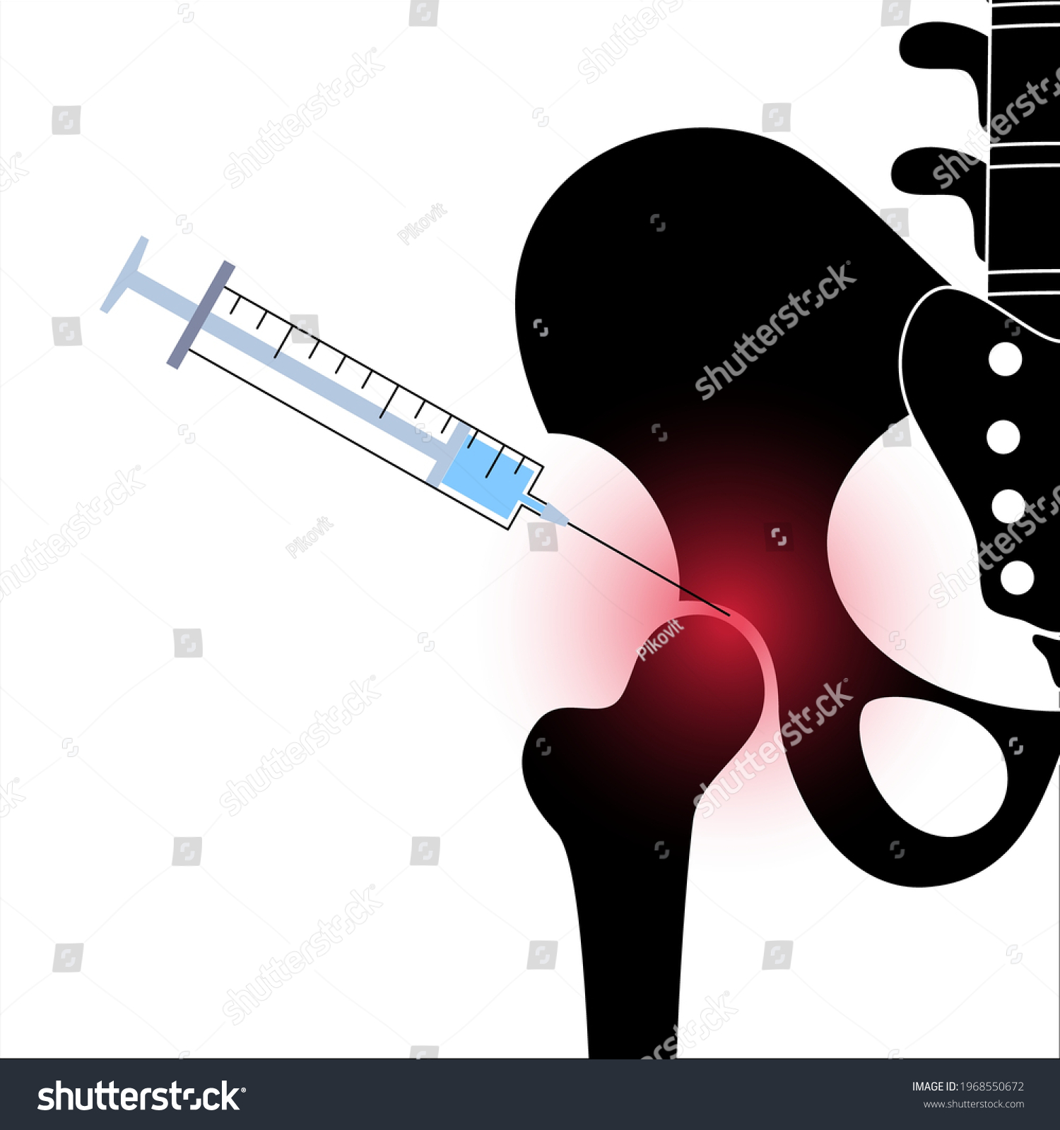 Hip Joint Cortisone Injection Pain Inflammation Stock Vector (Royalty Free) 1968550672