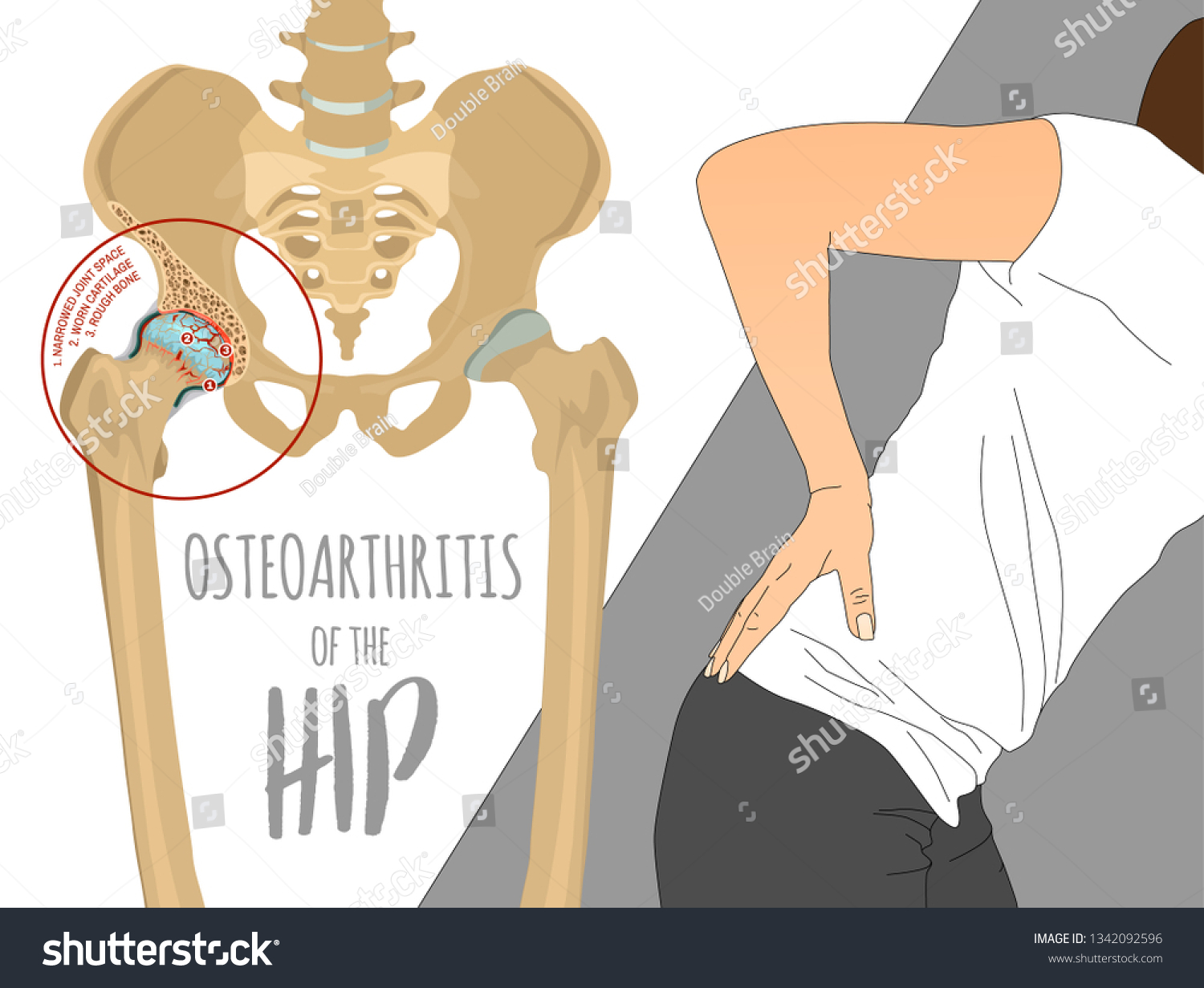 Hip Osteoarthritis Infographic Realistic Bones Scheme Stock Vector ...