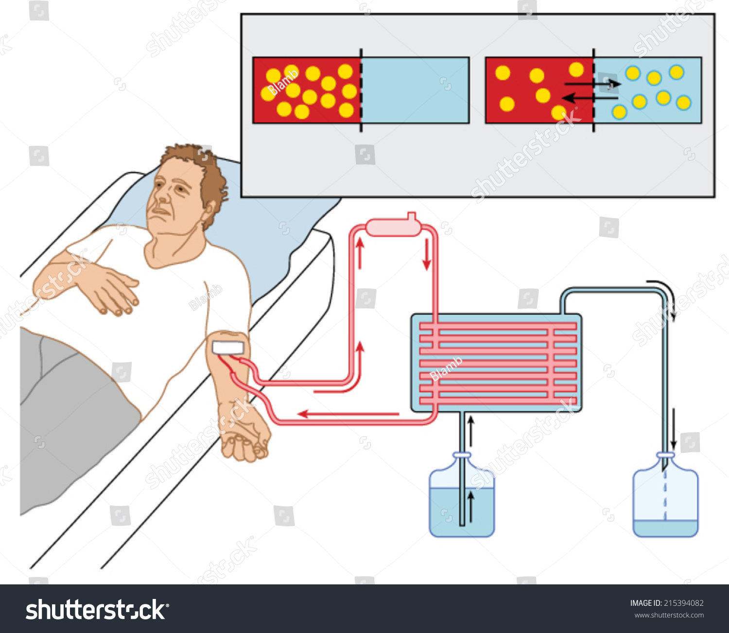 how-blood-dialysis-works-showing-patient