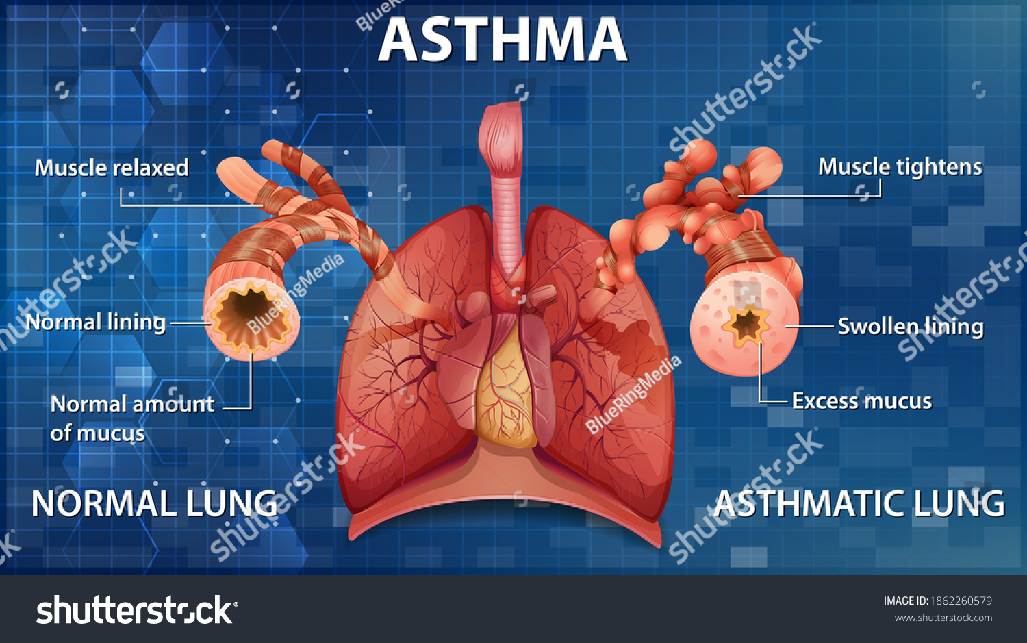 Asthma diagram Images, Stock Photos & Vectors | Shutterstock