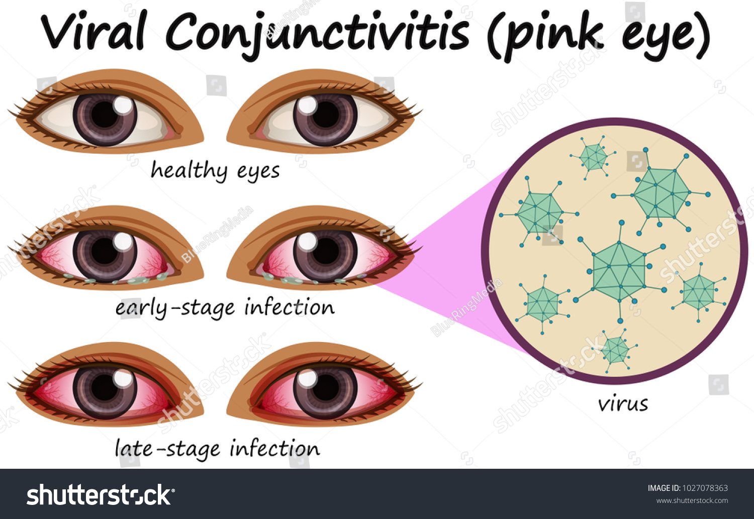 Human Eye Disease Viral Conjunctivitis Illustration Stock Vector ...