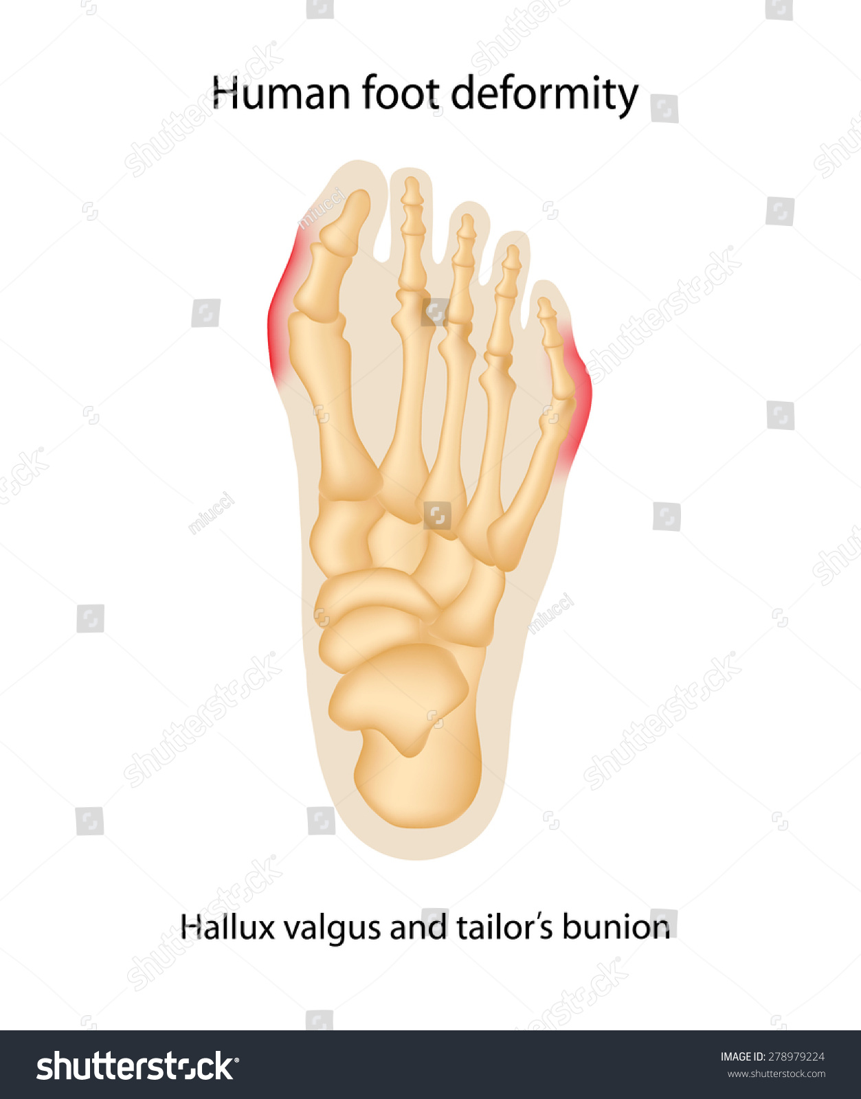 Human Foot Deformity Hallux Valgus Tailors Vector De Stock Libre De