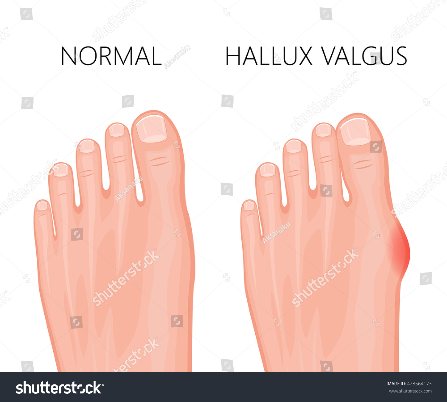 human-foot-deformity-hallux-valgus-used-stock-vector-royalty-free