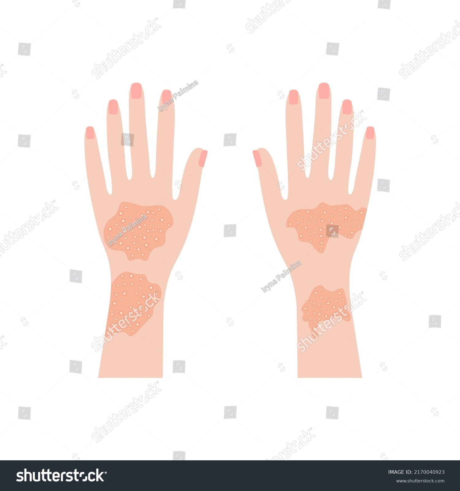 Human Hands Psoriasis Rashes Red Eczema Stock Vector (Royalty Free ...