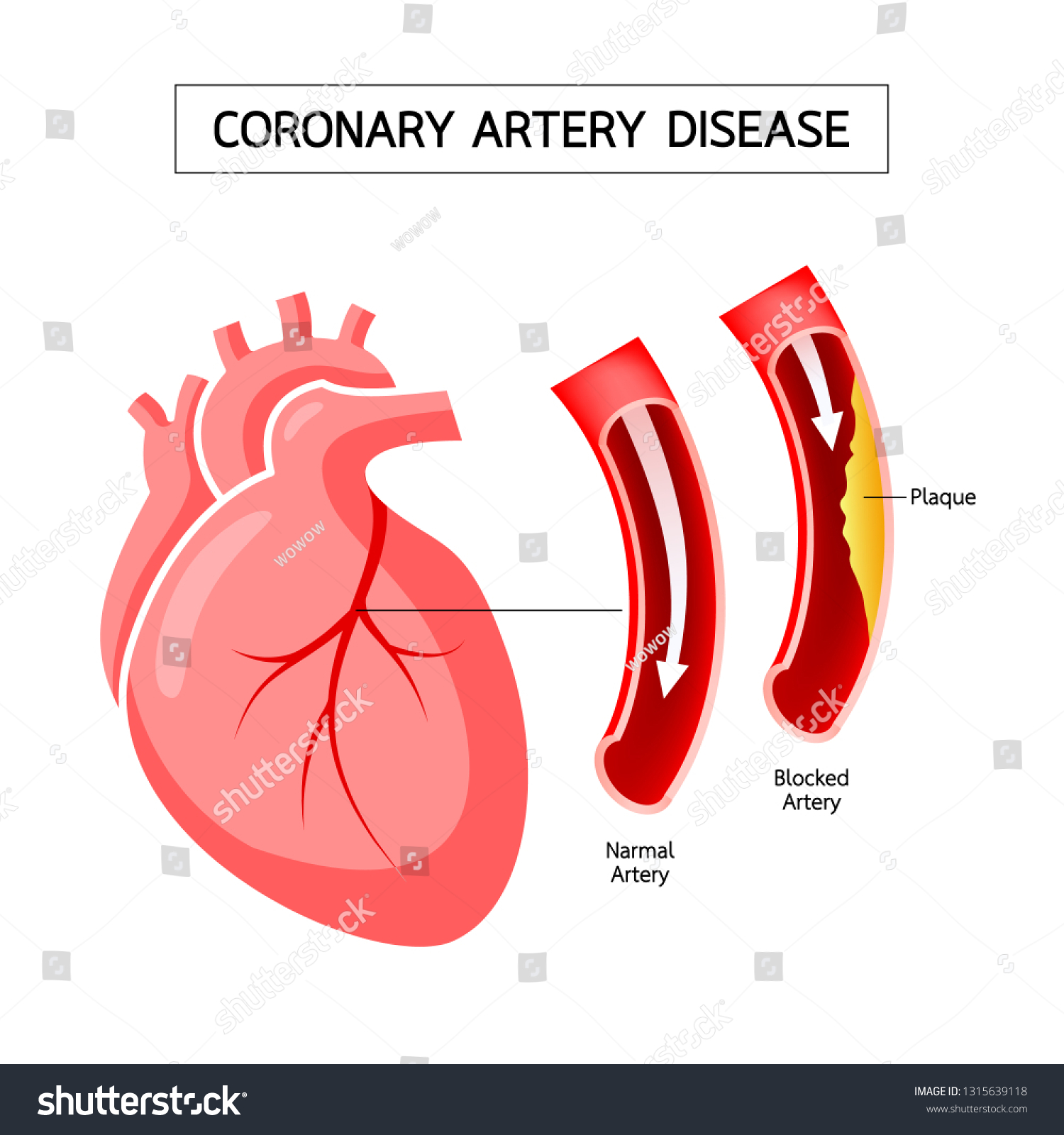 Human Heart Coronary Artery Disease Infographic Stock Vector (Royalty ...