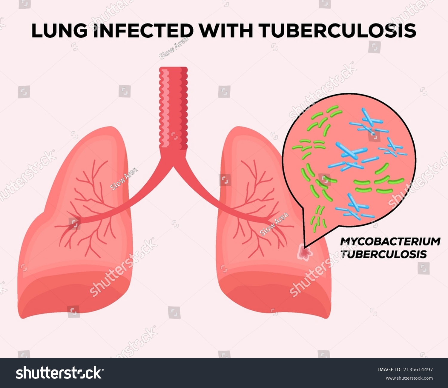 Human Lungs Infected Tuberculosis Stock Vector (Royalty Free ...