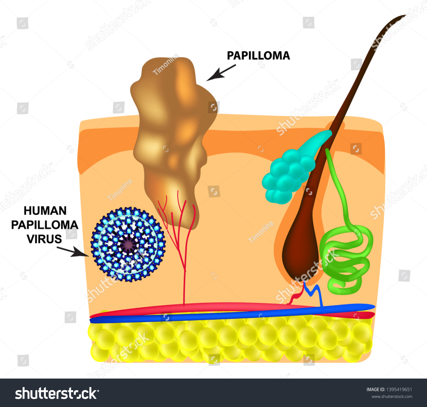 causes of papillomatosis papillomavirus 45