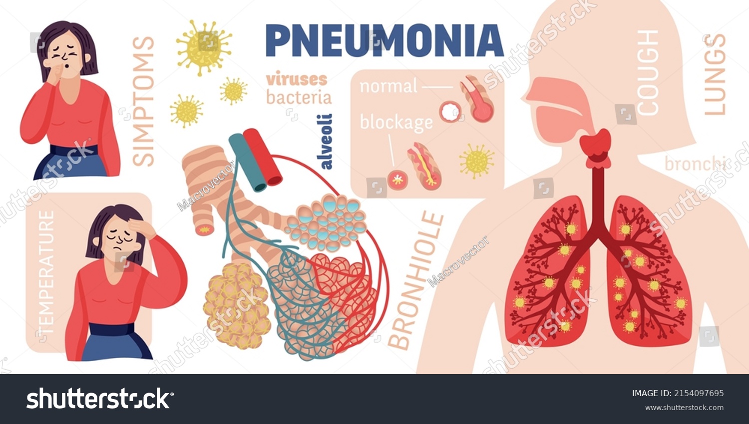 Human Pneumonia Infographics Cartoon Style Female Stock Vector (royalty 