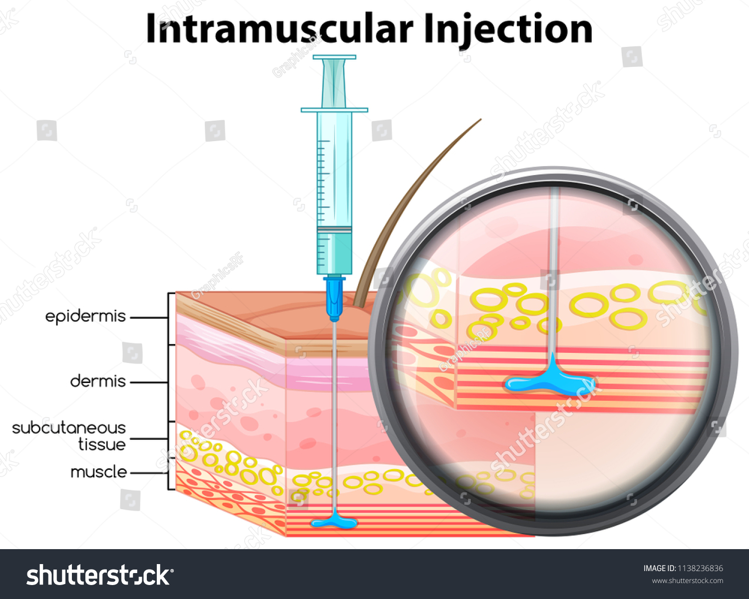 ヒト皮膚筋肉内注射イラスト のベクター画像素材 ロイヤリティフリー