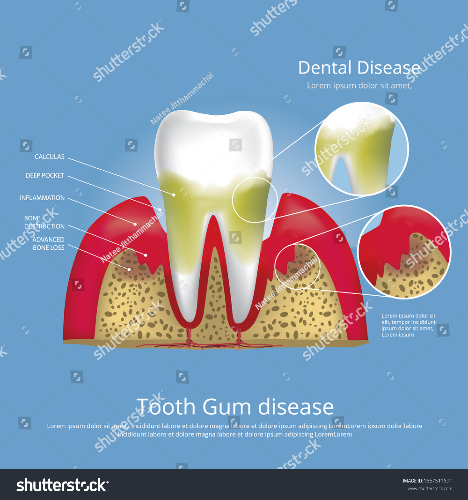 Human Teeth Stages Gum Disease Vector Stock Vector (Royalty Free ...