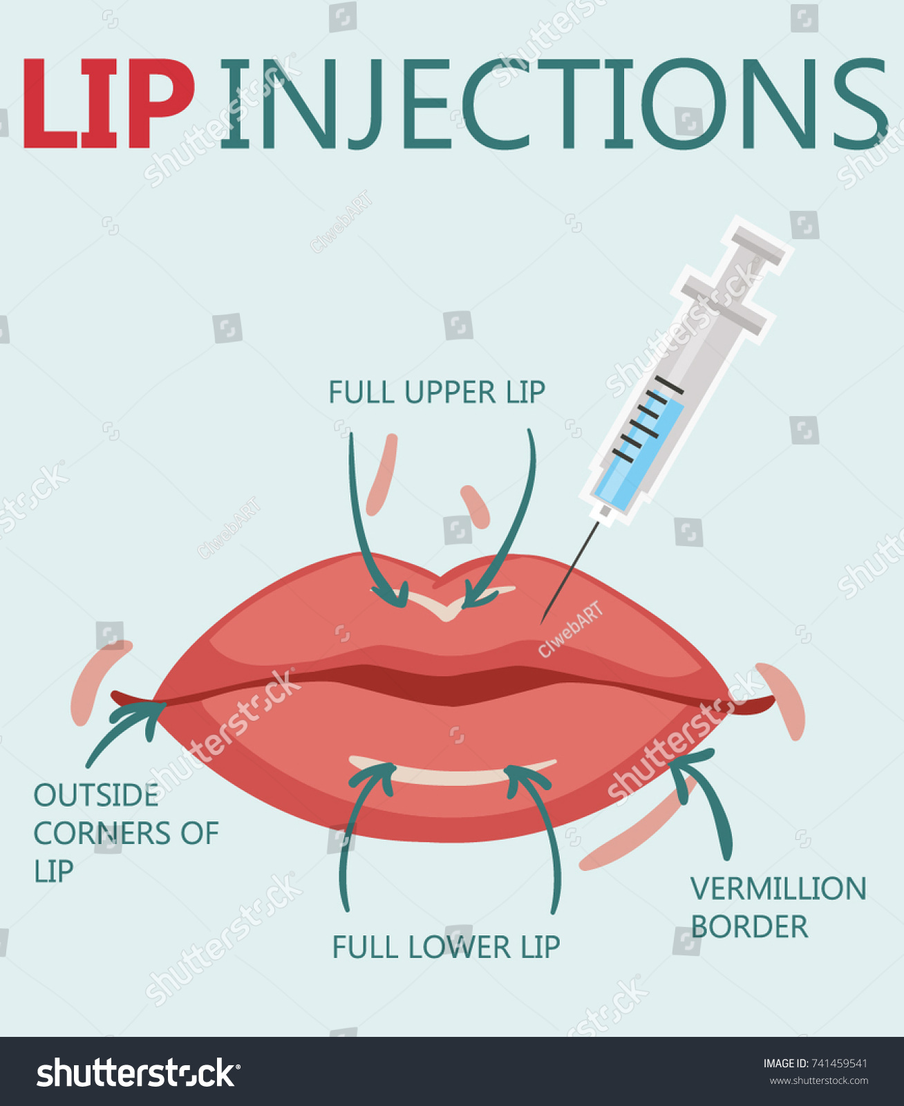 Vektor Stok Hyaluronic Acid Lip Injections Scheme Iconic Tanpa Royalti 741459541