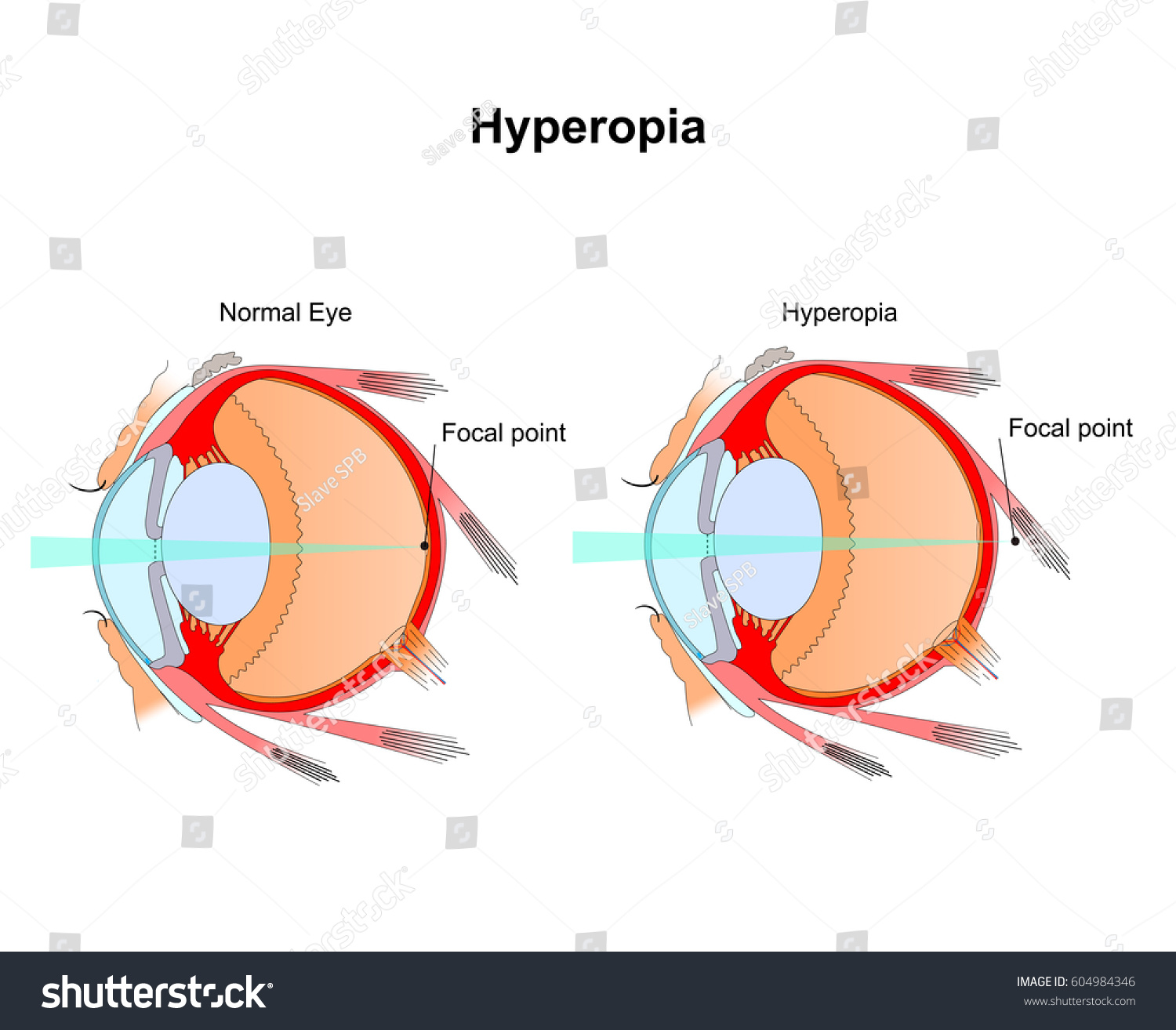 Hyperopia Eye Vision Disorderdiagram Eye Stock Vector