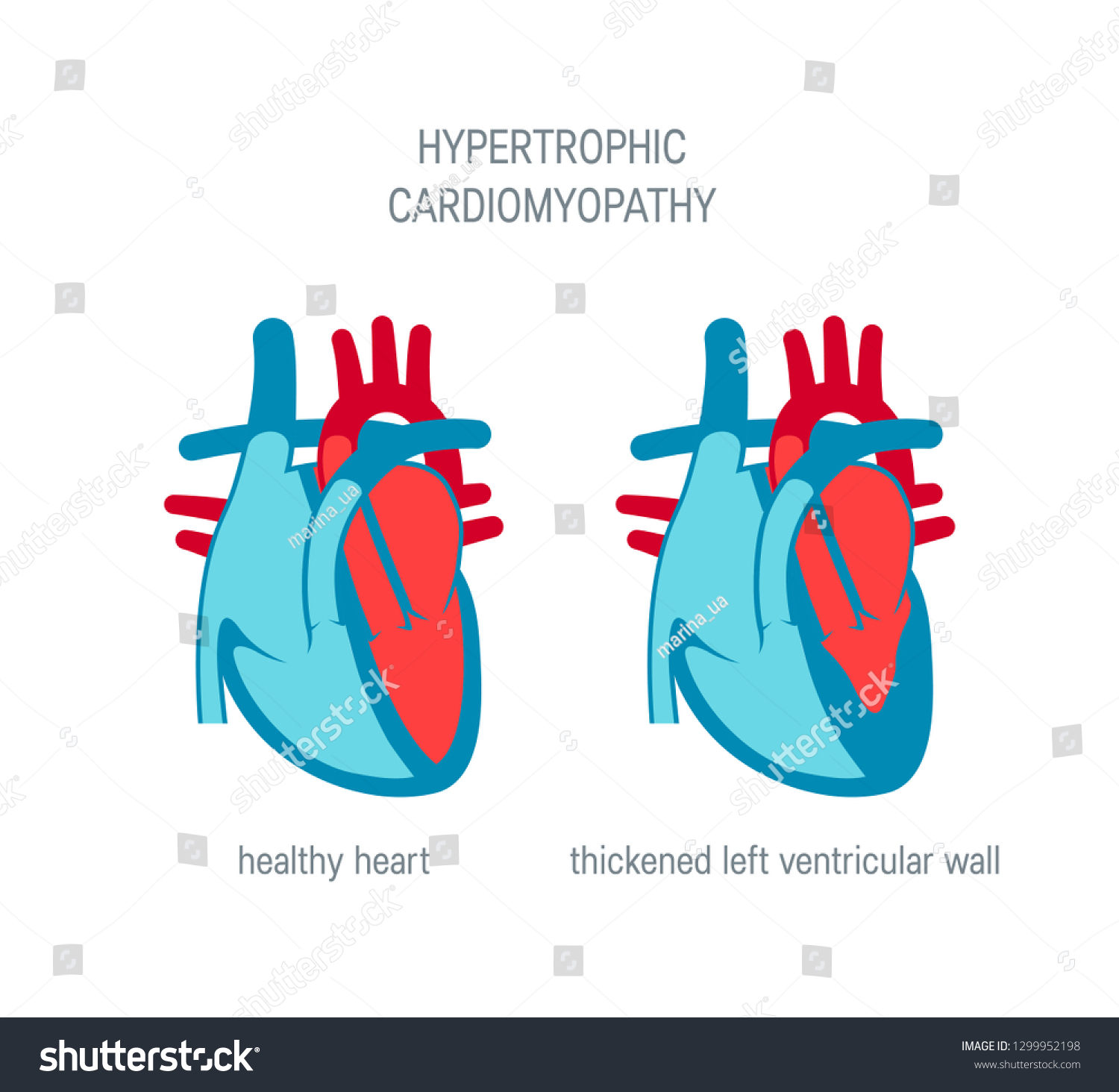 Hypertrophic Cardiomyopathy Disease Concept Vector Illustration Stock