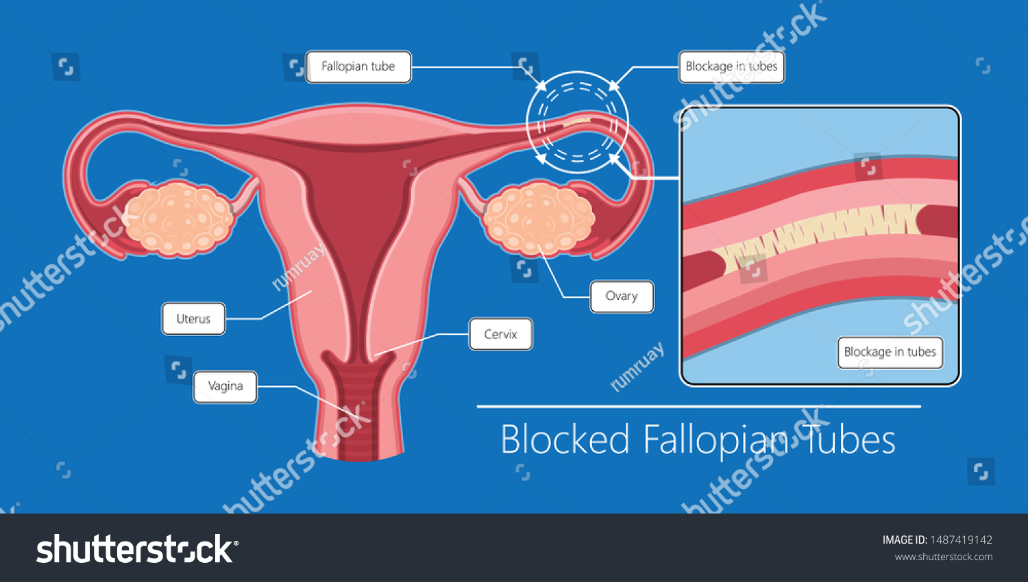 Hysterosalpingogram Hsg Test Blocked Fallopian Tubes Stock Vector