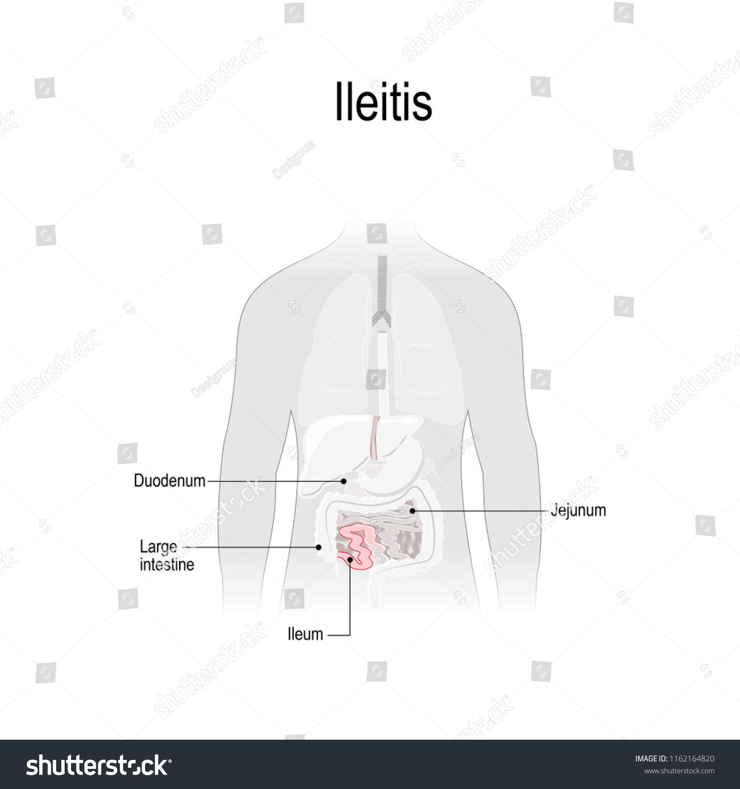 Ileitis Inflammation Ileum Part Small Intestine Stock Vector (Royalty ...