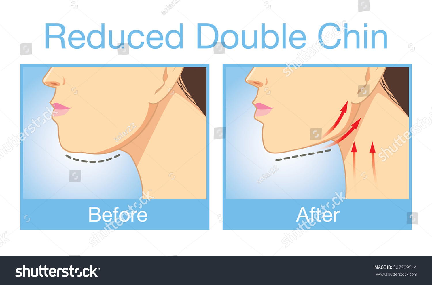 Vektor Stok Ilustrasi Sebelum Dan Sesudah Prosedur Untuk Tanpa Royalti   Stock Vector Illustration Before And After Procedure To Reduce A Double Chin 307909514 