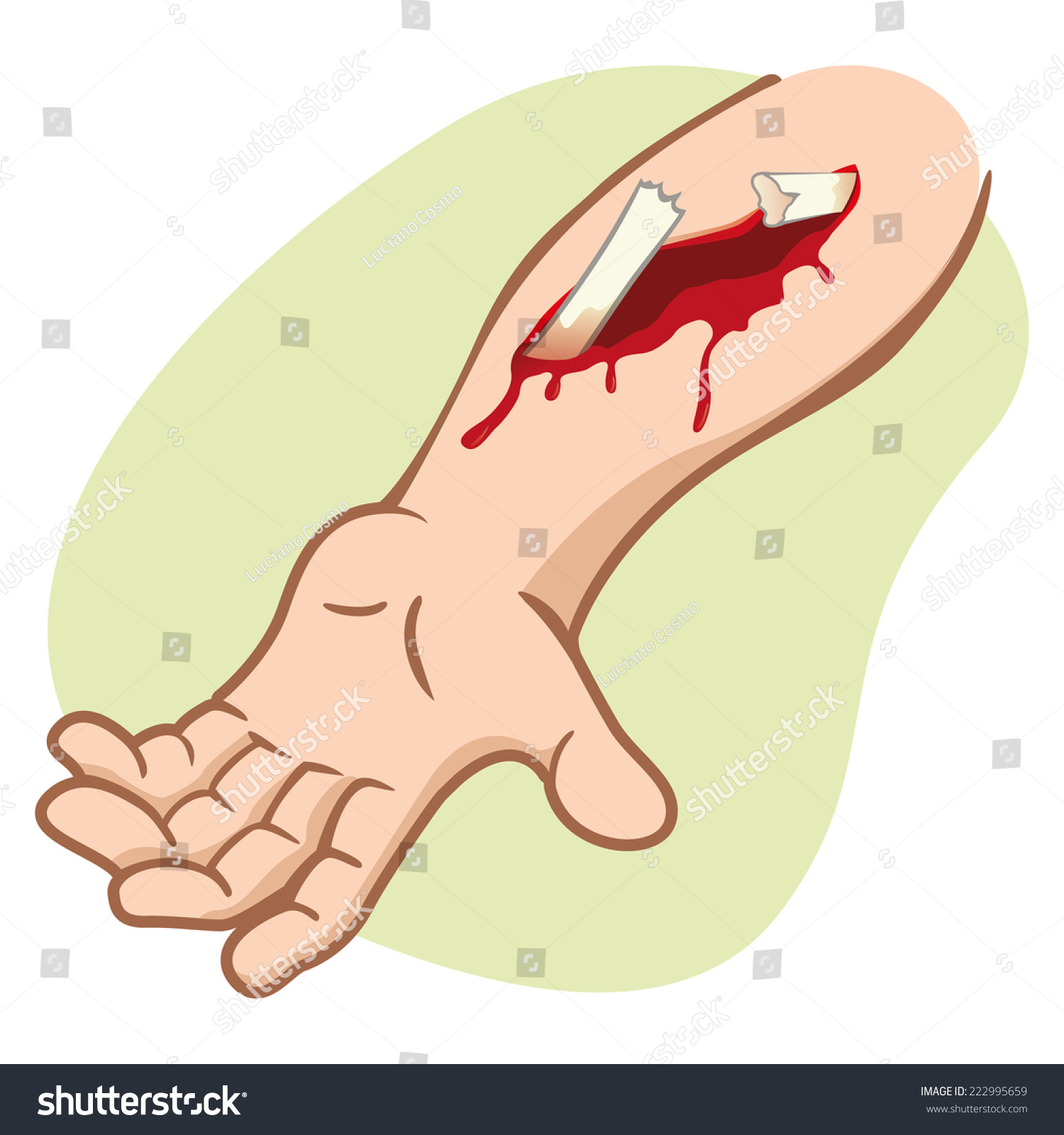 Illustration Human Arm Compound Fracture Showing Stock Vector 222995659 ...