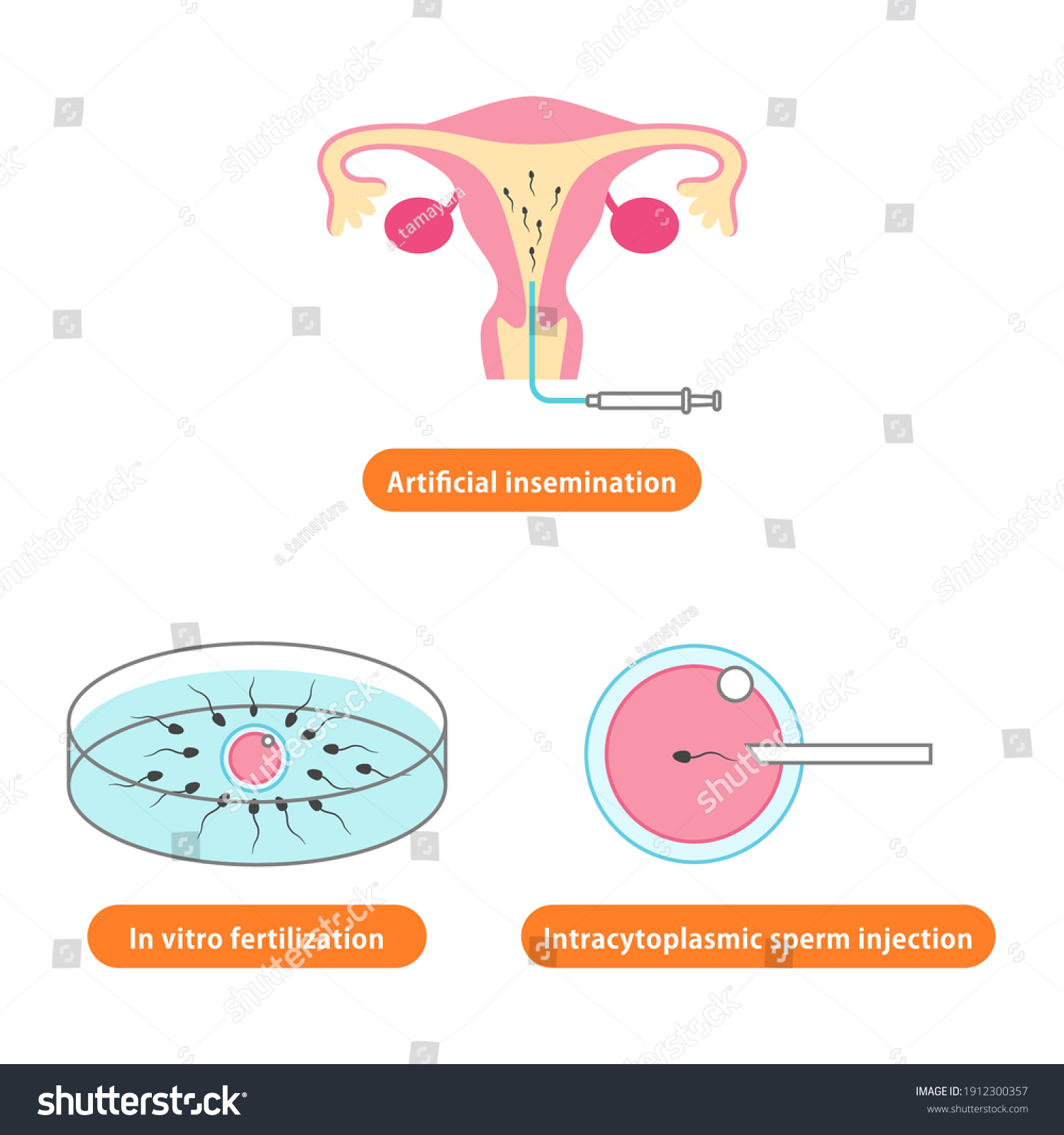 Illustration Artificial Insemination Vitro Fertilization Intracytoplasmic Stock Vector Royalty 5167