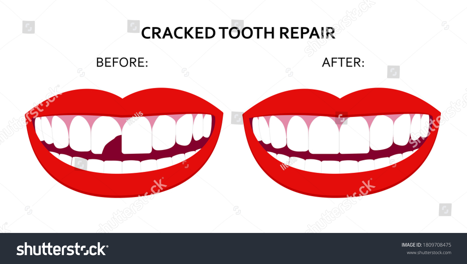 Illustration Cracked Tooth Repair Smile Mouth Stock Vector (Royalty