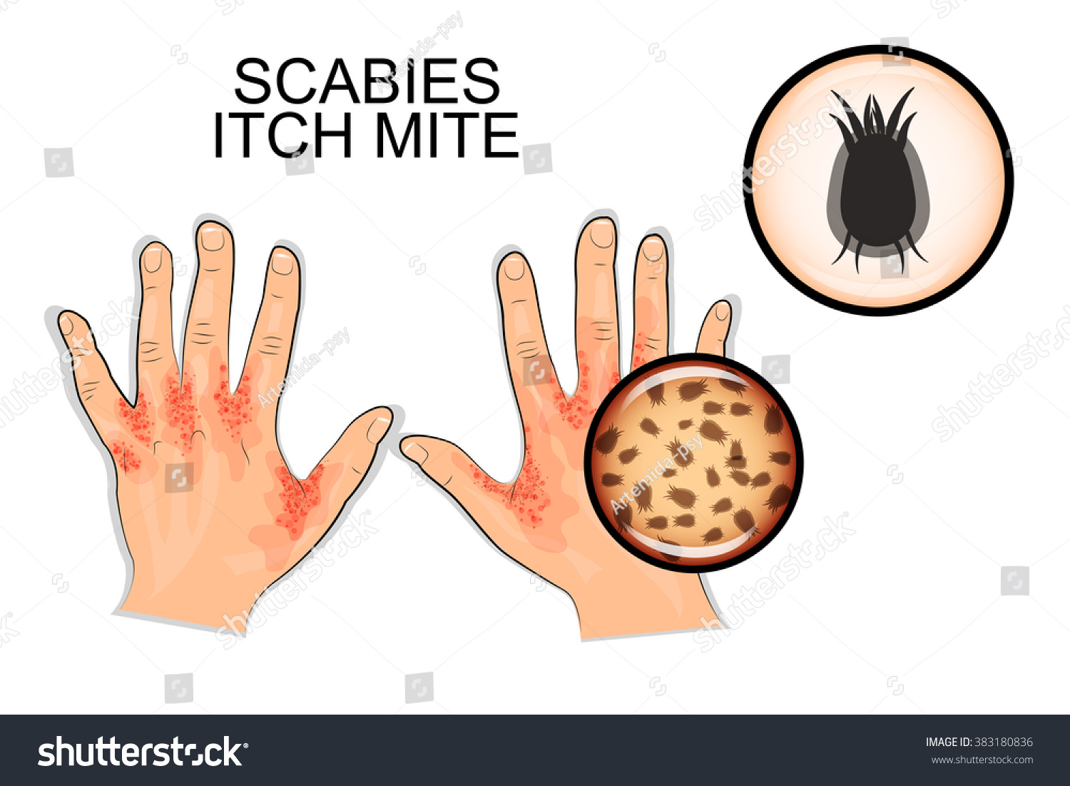 Illustration Hand Infected Scabies Scabies Mite Stock Vector