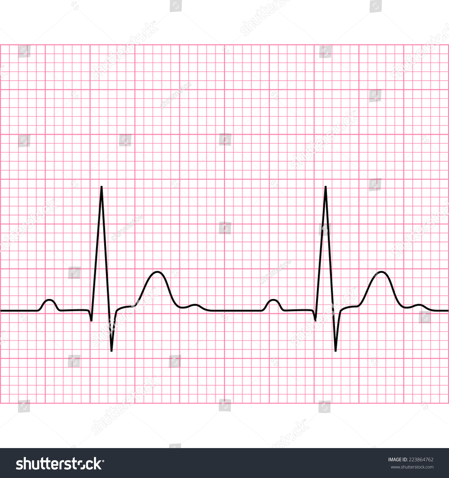 Illustration Of Medical Electrocardiogram - Ecg On Chart Paper, Graph ...