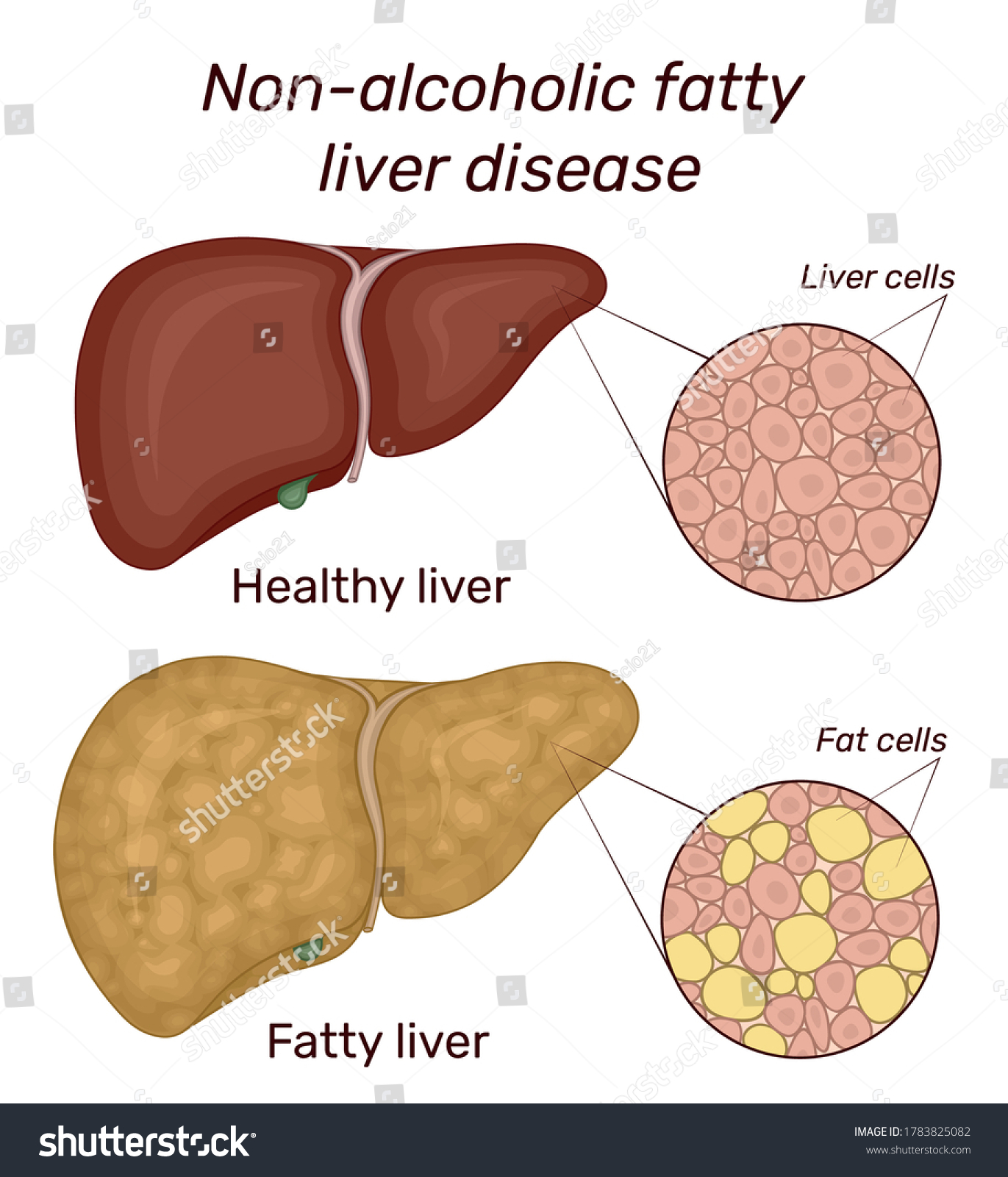 Vektor Stok Illustration Nonalcoholic Fatty Liver Disease Comparison ...