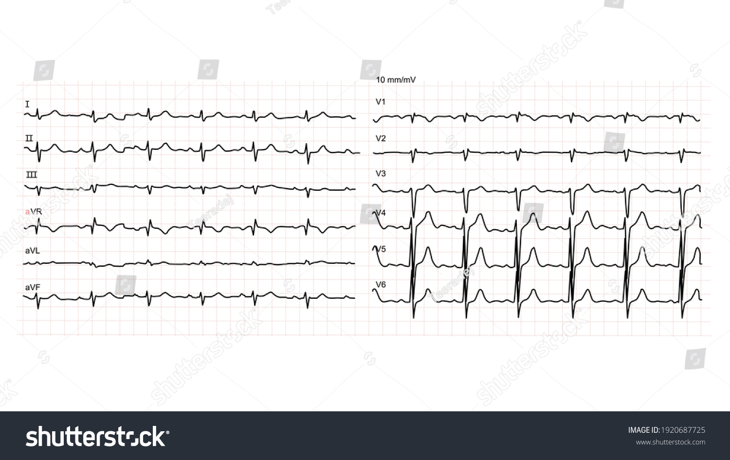 Illustration Normal Human Electrocardiogram Ekg 12 Stock Vector ...