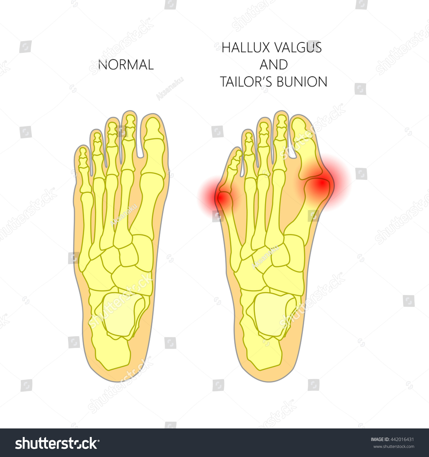 Illustration Normal Foot Valgus Deviation First Stock Vector (Royalty ...