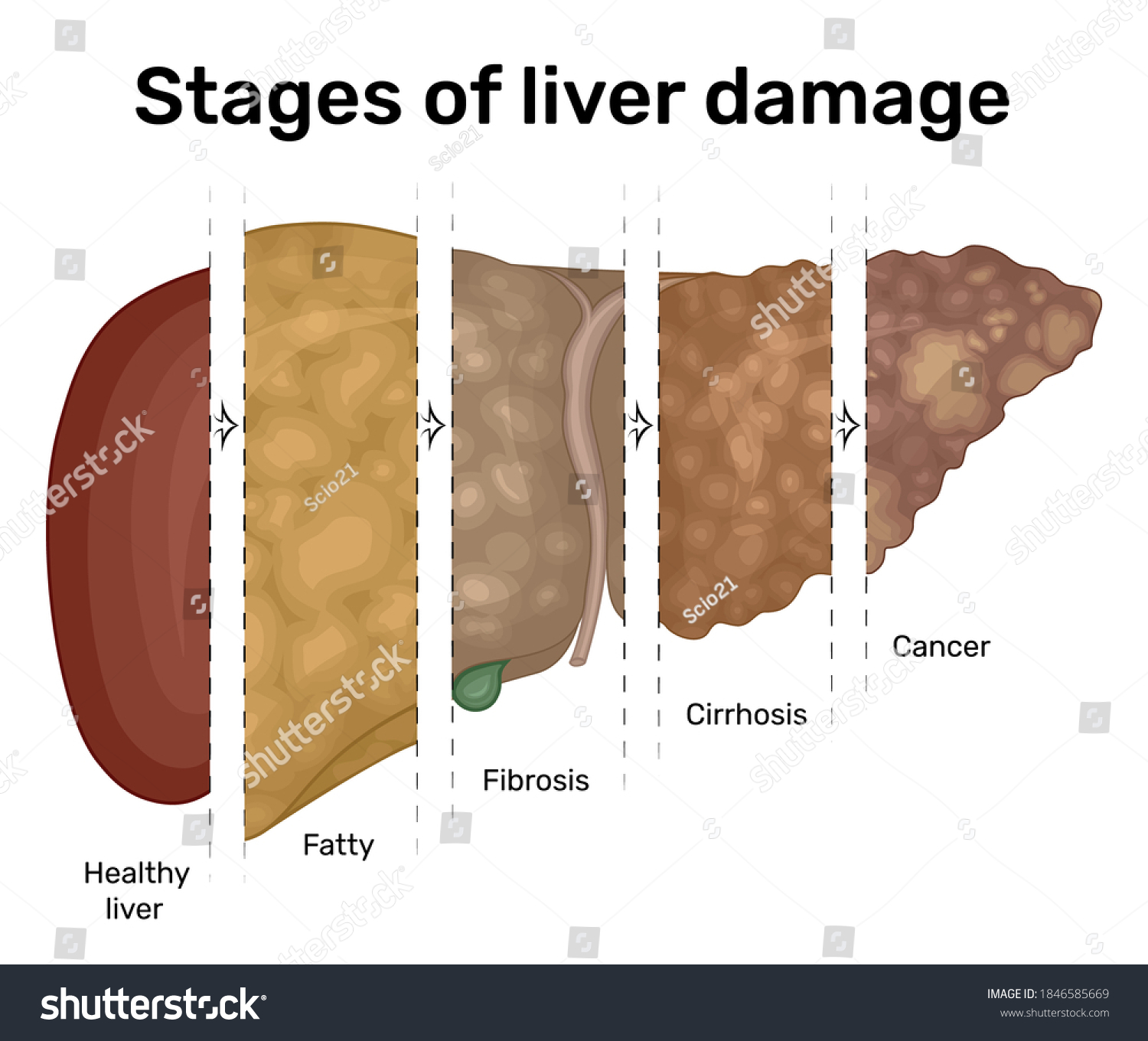 549 Stages liver disease Images, Stock Photos & Vectors | Shutterstock