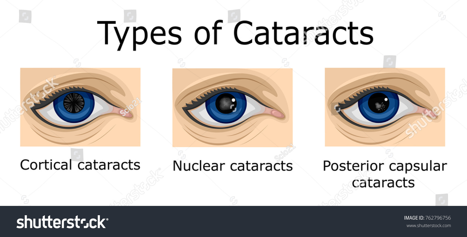 Illustration Three Types Cataracts Such Cortical Stock Vector Royalty