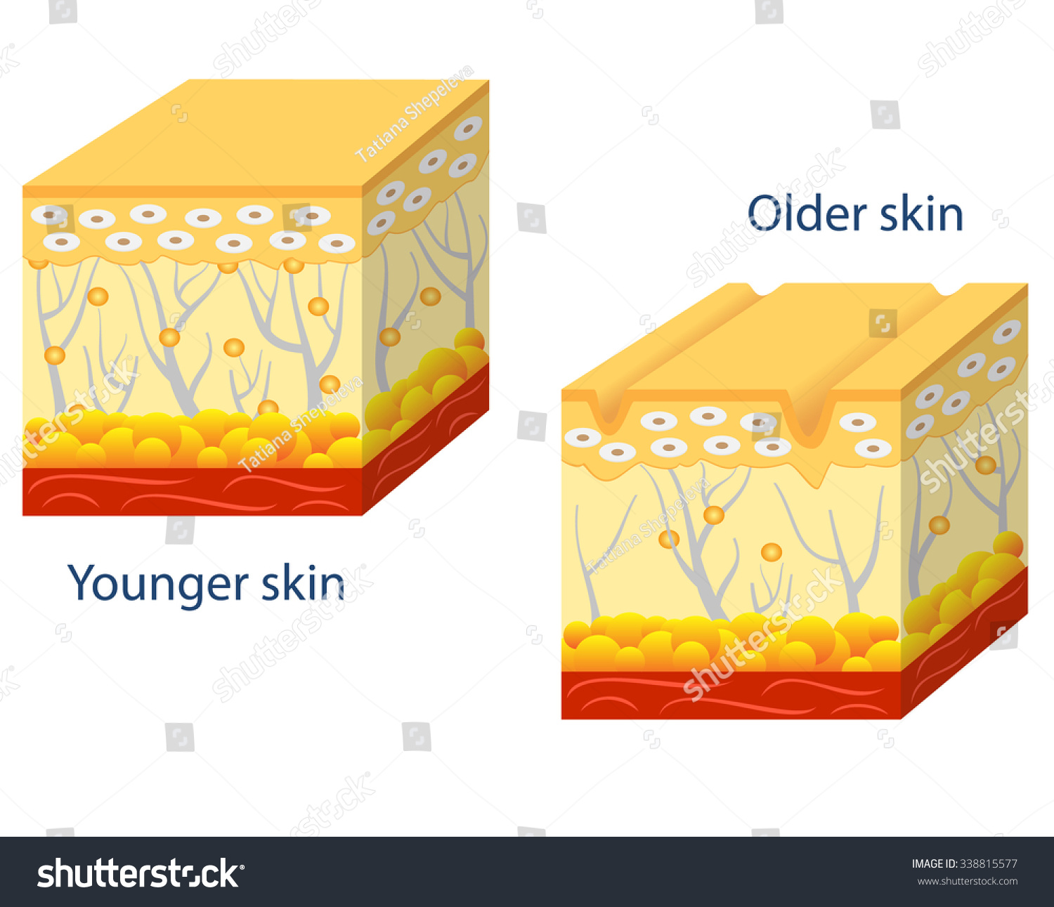 Illustration Of Younger Skin And Aging Skin Showing The Decrease In ...