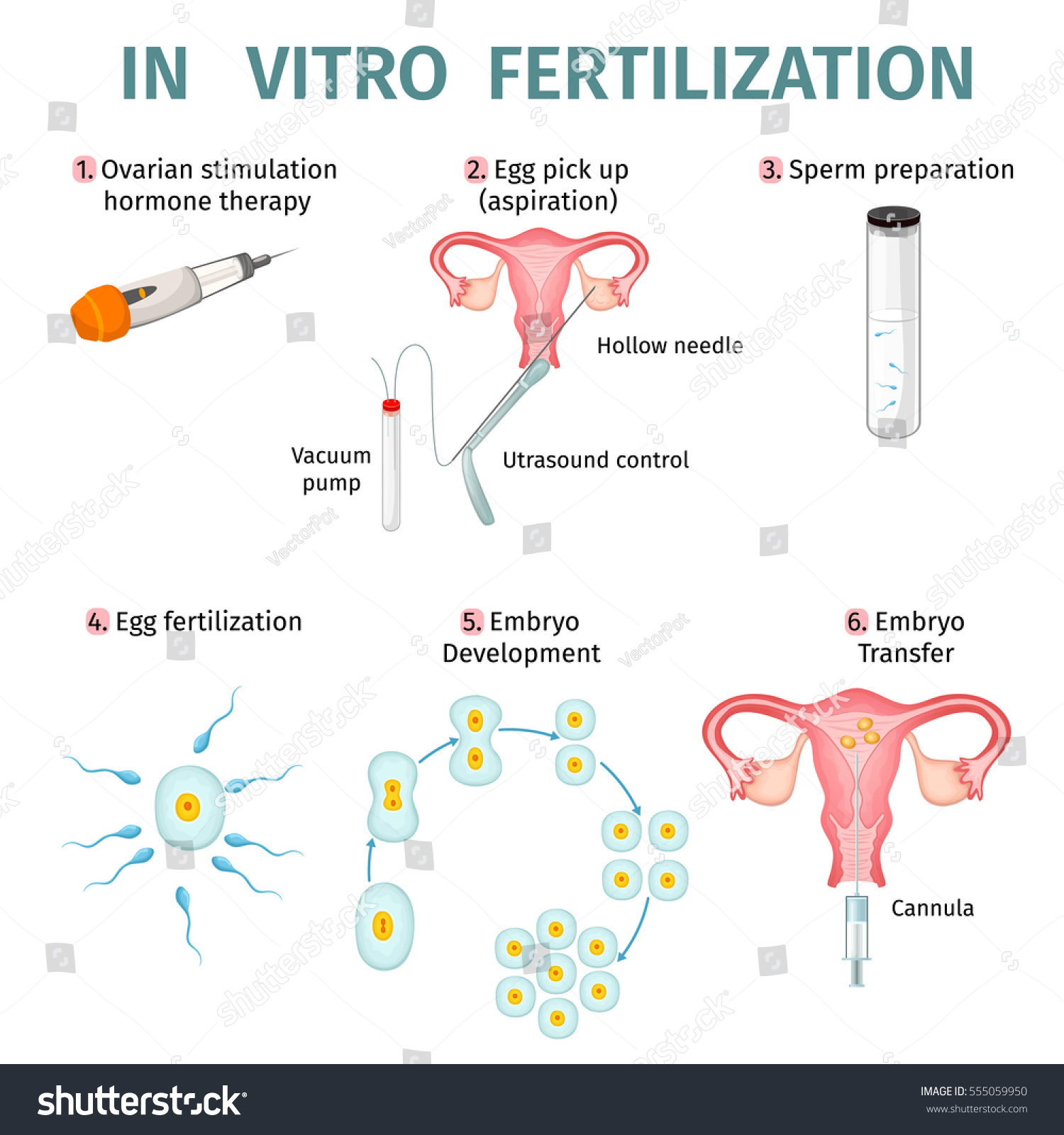 Vitro Fertilization Concept Steps Procedures Artificial Stock Vector Royalty Free 555059950 