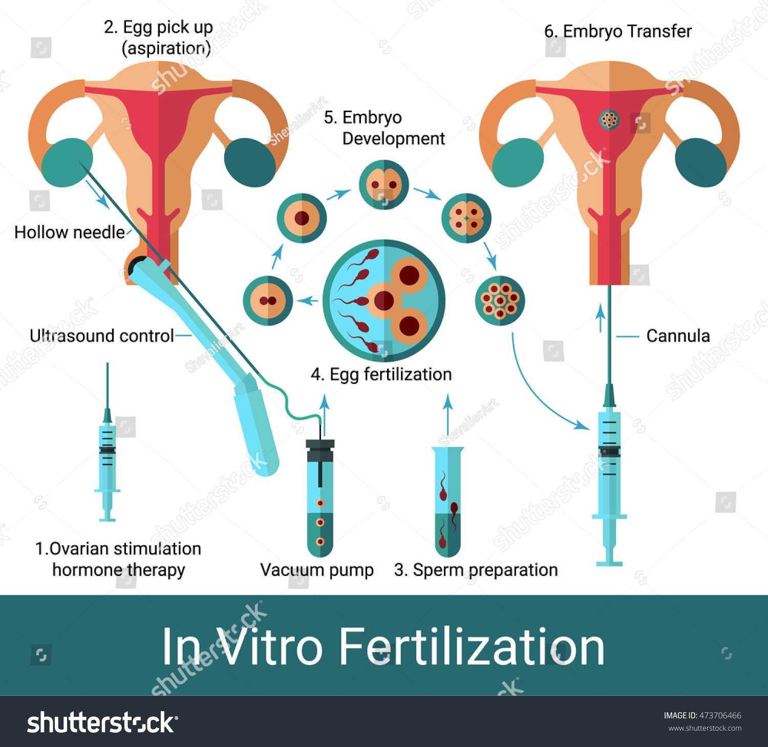 Stock Vektor „infografická Tabulka In Vitro Oplodnění V“ Bez Autorských Poplatků 473706466 3220