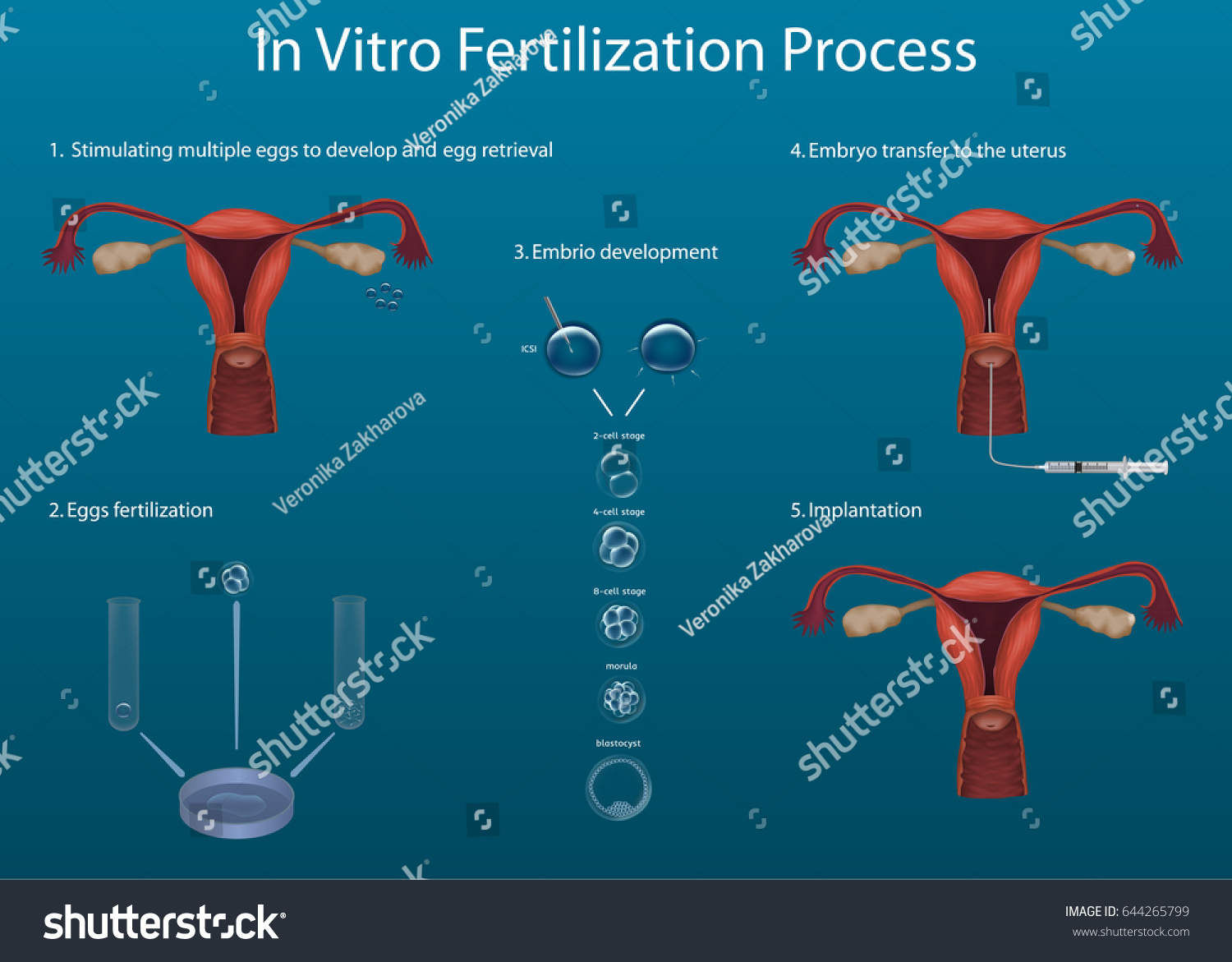 Vektor Stok Vitro Fertilization Process Medical Illustration Vector Tanpa Royalti 644265799