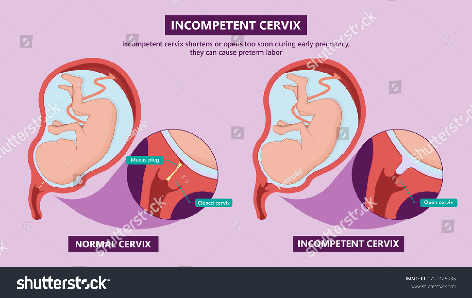 Incompetent Cervix Cervical Insufficiency Weak Tissue Stock Vector Royalty Free 1747425935