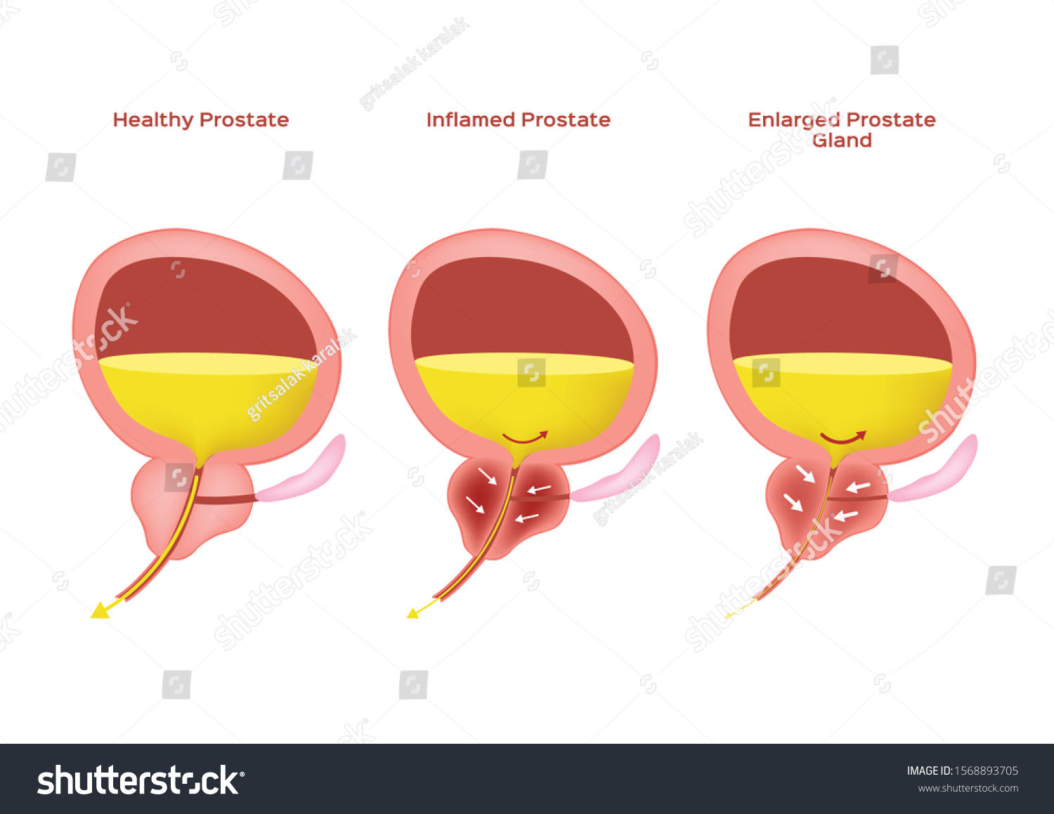 Inflamed Prostate Enlarged Prostate Gland Benign Stock Vector Royalty Inflamed Prostate Enlarged Prostate Gland Benign Stock Vector Royalty