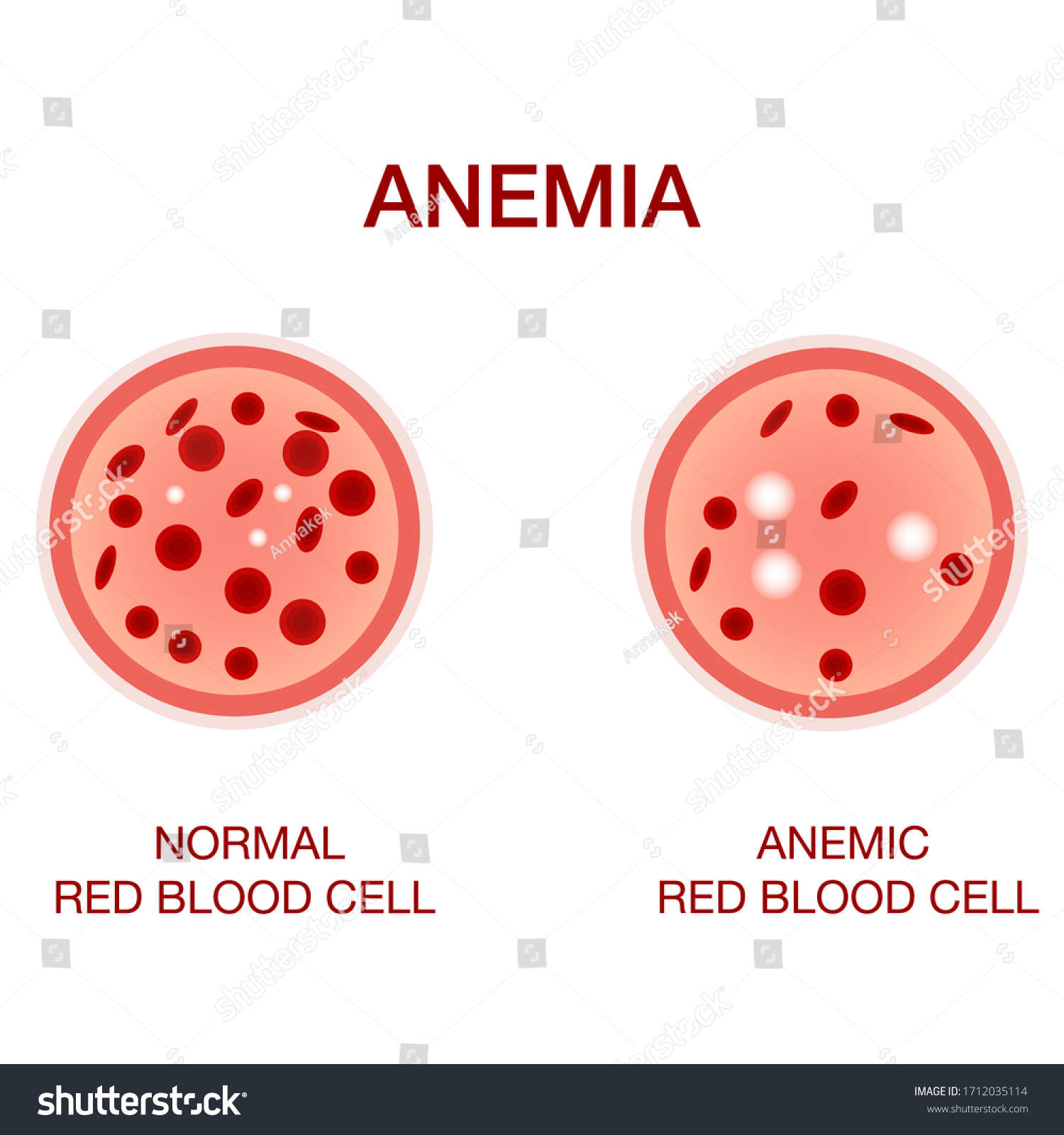 Infographic Image Anemia Difference Anemia Amount Stock Vector Royalty Free 1712035114 6640