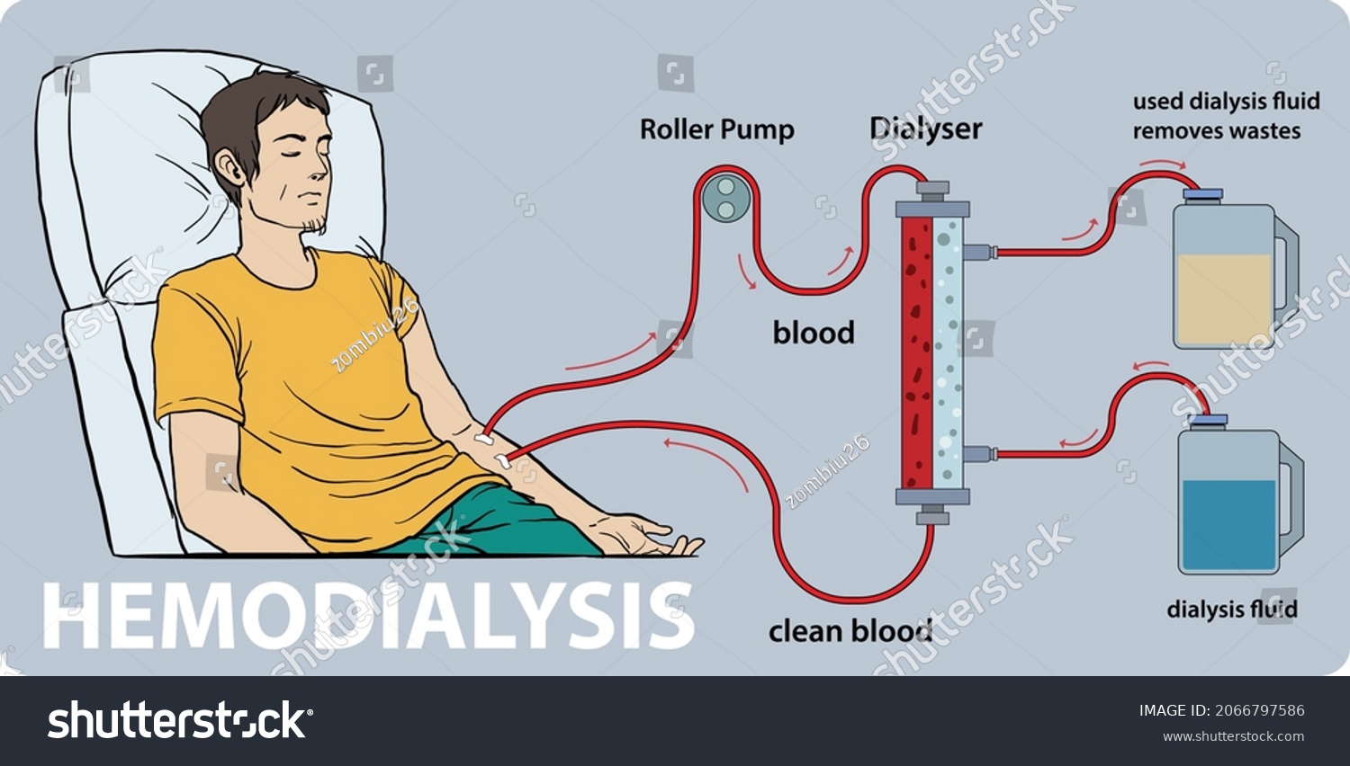 Infographic Hemodialysis Procedure Where Dialysis Machine 库存矢量图（免版税