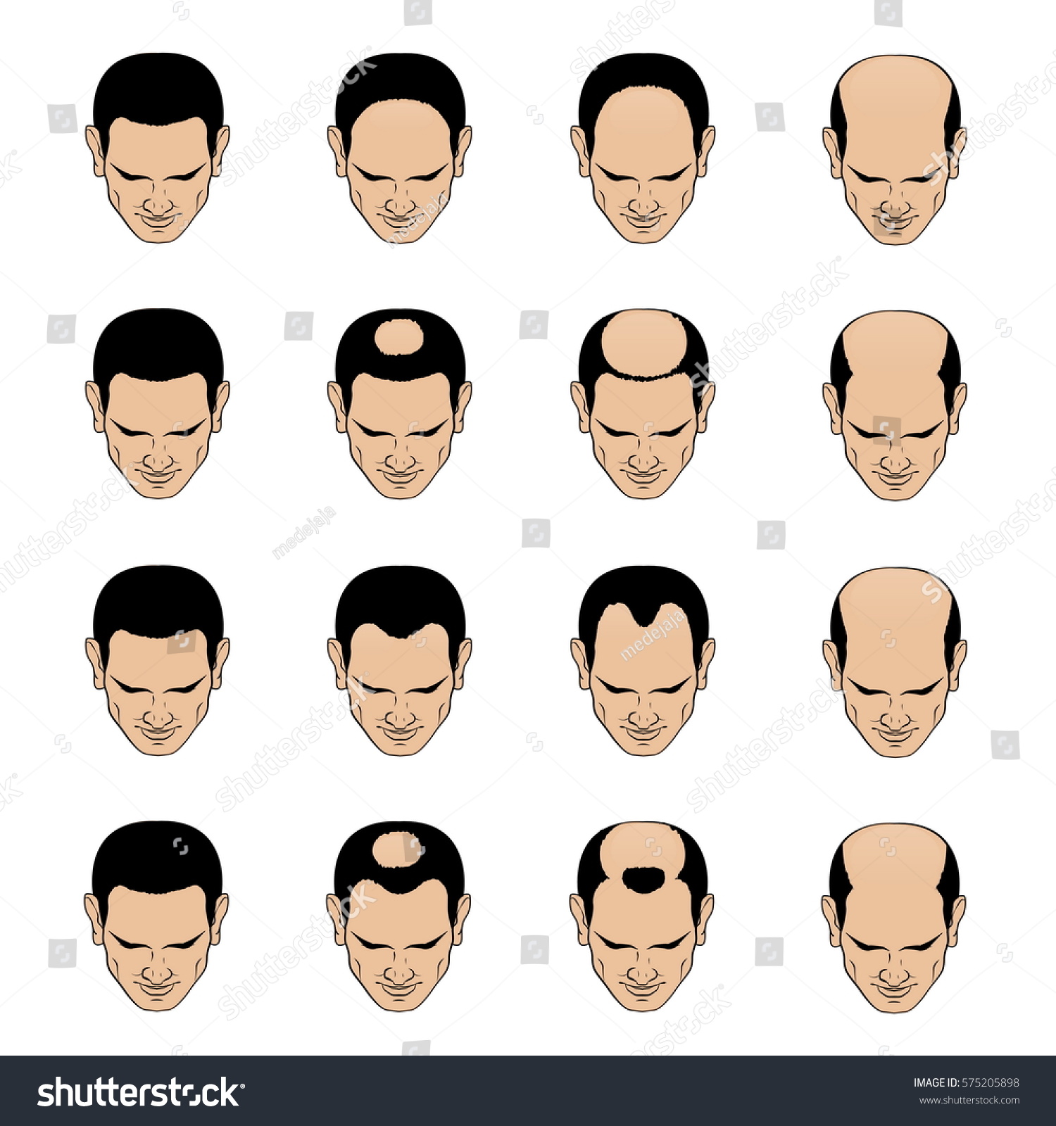 https://image.shutterstock.com/z/stock-vector-information-chart-showing-types-and-stages-of-hair-loss-for-men-bolding-head-from-full-hair-cover-575205898.jpg