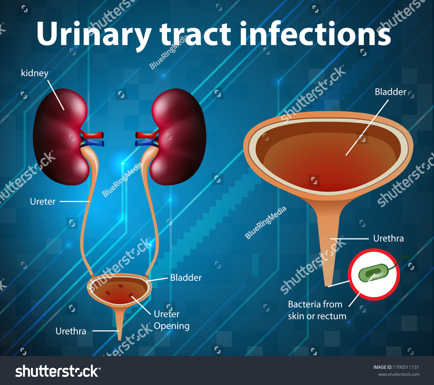 Informative Illustration Urinary Tract Infections Illustration Stock