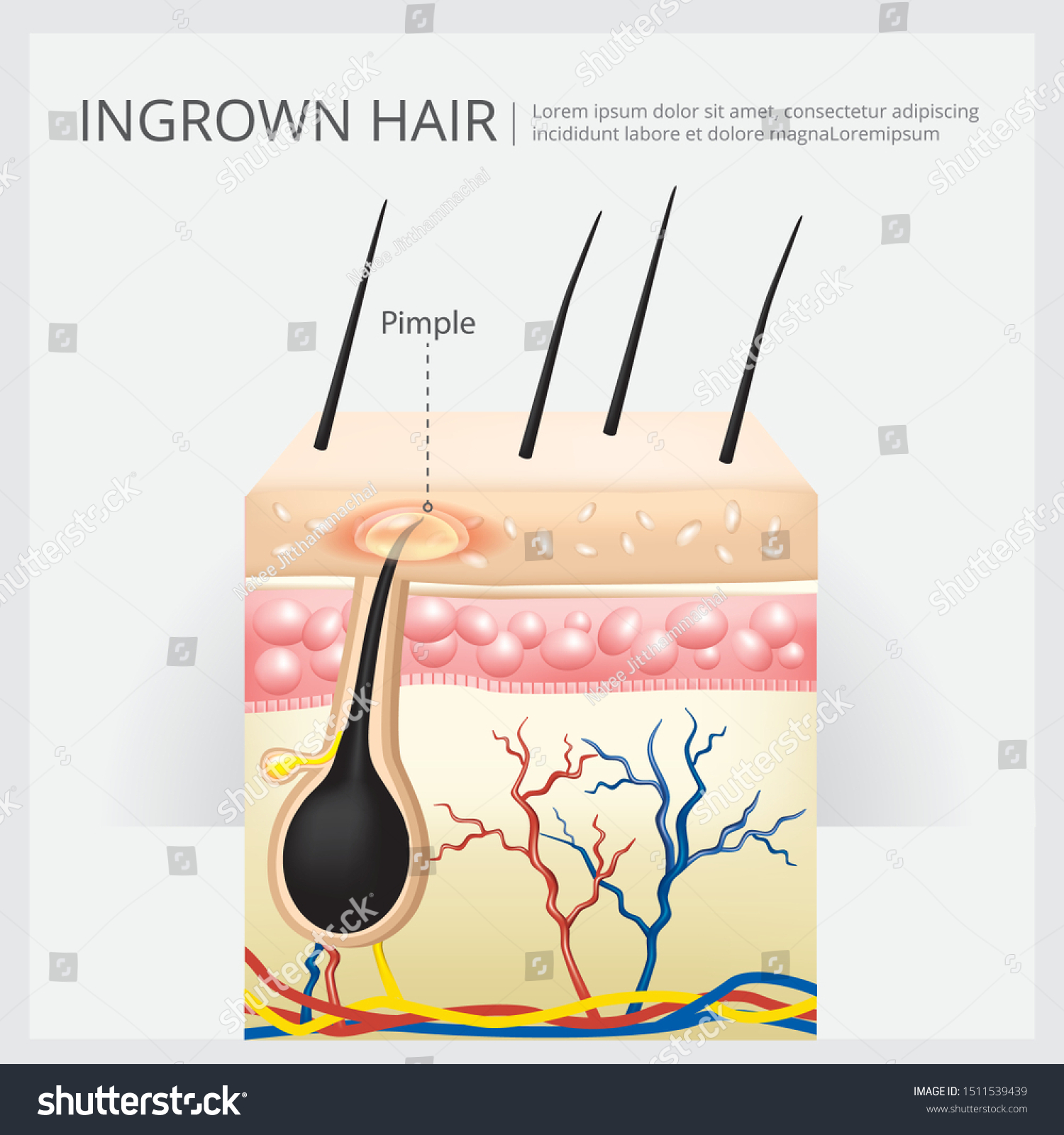 Ingrown Hair Structure Vector Illustration Stock Vector (Royalty Free ...