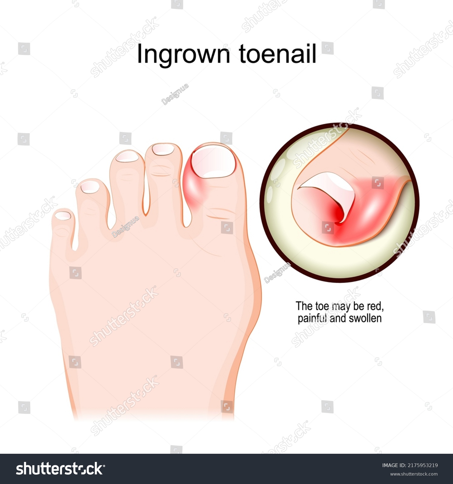 Ingrown Toenail Human Foot Closeup Red Stock Vector (Royalty Free ...