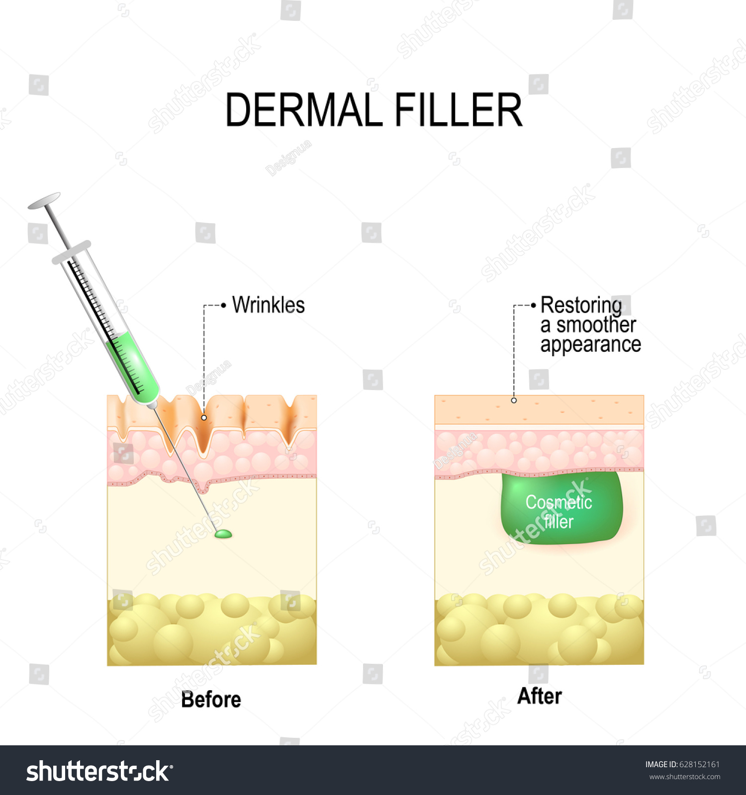 Injectable Cosmetic Filler Dermal Fillers Stock Vector Royalty Free