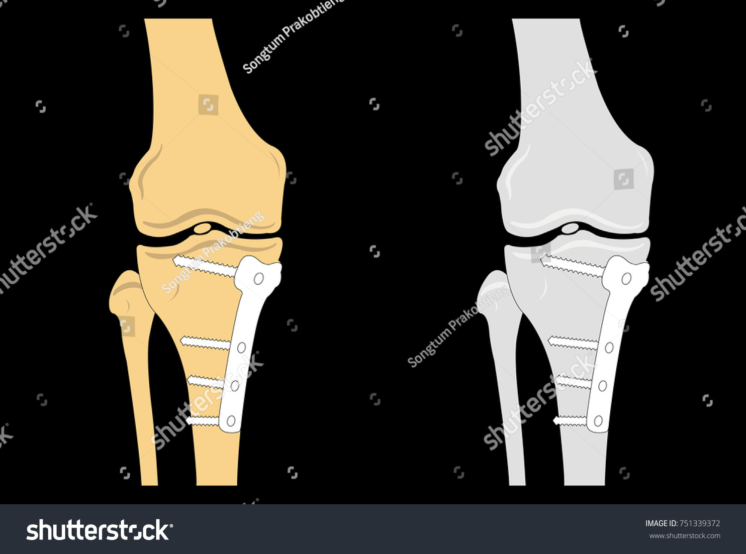 SVG of Internal Fixation of Fractures, Plate and Screws Vector illustration svg