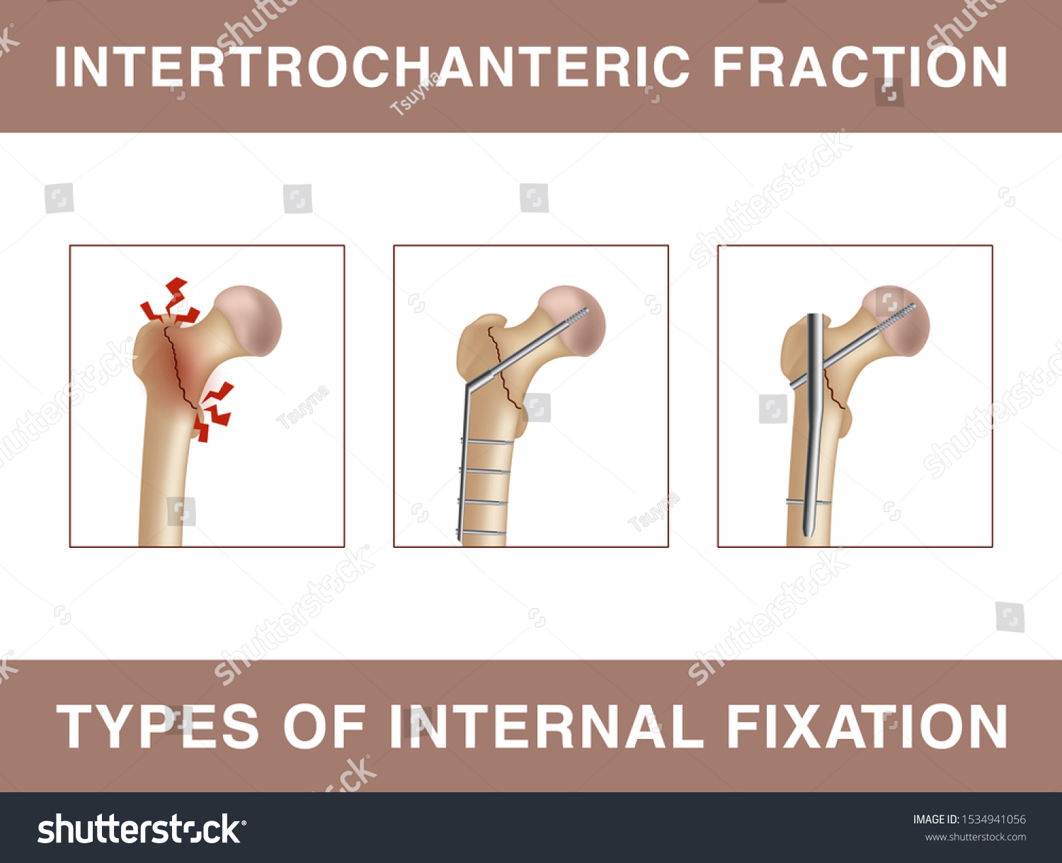SVG of Intertrochanteric fracture. Types of internal fixation. Vector illustration showing the strengthening of the bone fracture using screws, rods, pins, or plates. svg