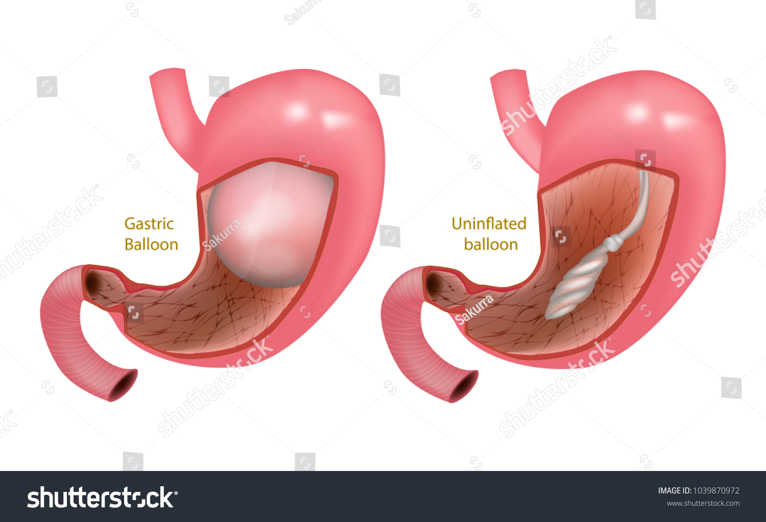 SVG of Intra Gastric Balloon. Orbera Gastric Ballon Inside a Stomach svg