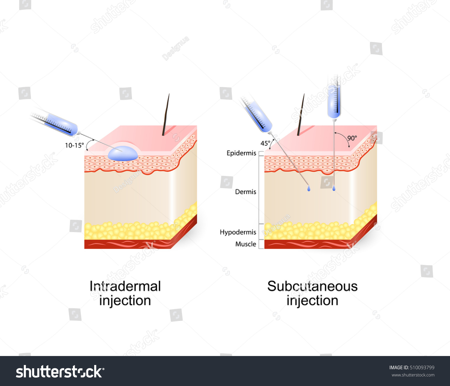 Intradermal And Subcutaneous Injection Stock Vector